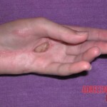 Rattlesnake bite