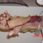 Rattlesnake bite