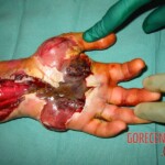 Rattlesnake bite