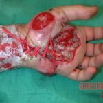 Rattlesnake bite