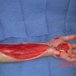 Rattlesnake bite
