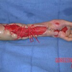 Rattlesnake bite