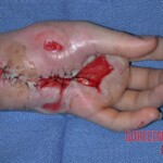 Rattlesnake bite