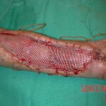 Rattlesnake bite