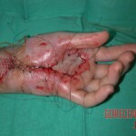Rattlesnake bite