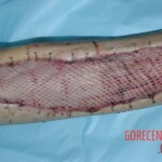 Rattlesnake bite