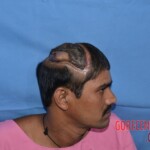 Skin auto-transplantation