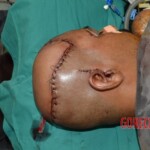 Skin auto-transplantation