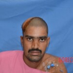 Skin auto-transplantation