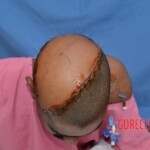 Skin auto-transplantation