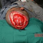 Skin auto-transplantation