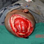 Skin auto-transplantation