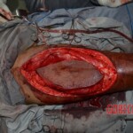 Skin auto-transplantation