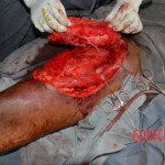 Skin auto-transplantation