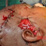 Skin auto-transplantation