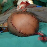 Skin auto-transplantation