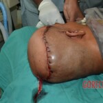 Skin auto-transplantation