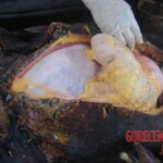 Burnt pregnant woman autopsy