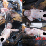 Autopsy of burnt pregnant woman