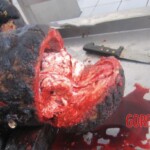 Burnt pregnant woman autopsy