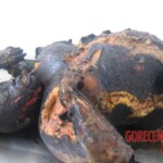 Burnt pregnant woman autopsy