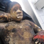 Burnt pregnant woman autopsy