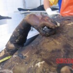 Burnt pregnant woman autopsy