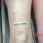 Autopsy of blonde woman