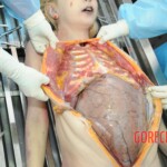 Autopsy of blonde woman