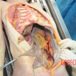 Autopsy of blonde woman