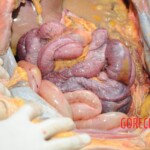 Autopsy of blonde woman