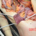 Autopsy of blonde woman