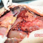 Autopsy of blonde woman