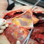 Autopsy of blonde woman