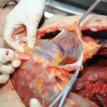 Autopsy of blonde woman