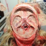 Autopsy of blonde woman