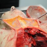 Autopsy of blonde woman