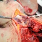 Autopsy of blonde woman