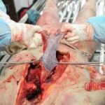 Autopsy of blonde woman