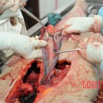 Autopsy of blonde woman