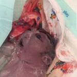 Anencephaly