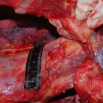 Autopsy on Chinese female