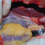 Autopsy on Chinese female