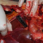 Autopsy on Chinese female