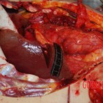 Autopsy on Chinese female