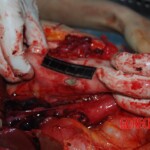 Autopsy on Chinese female