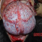 Autopsy on Chinese female