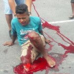 Amputated leg in accident