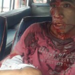 Amputated leg in accident