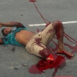 Amputated leg in accident